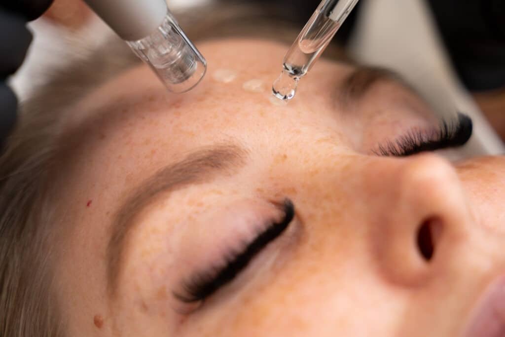 Microneedling Behandlung